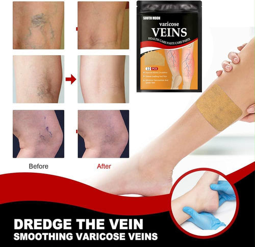 South Moon Varicose Veins Health Care Patch | 12 Pcs | Improve Circulation & Relieve Swelling