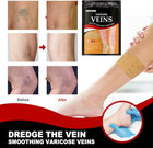 South Moon Varicose Veins Health Care Patch | 12 Pcs | Improve Circulation & Relieve Swelling 1
