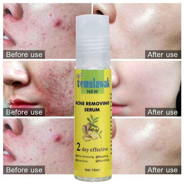 Temulawak Facial Serum for Acne-Prone Skin